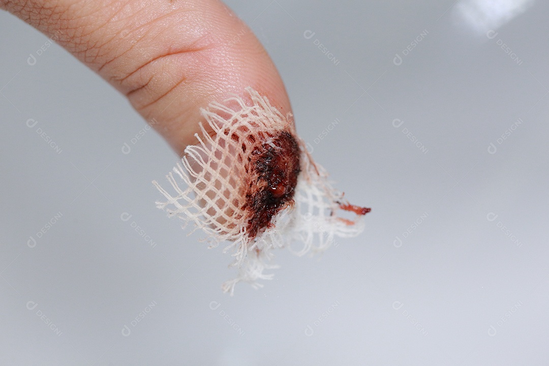 Close-up vista do dedo na mão humana do polegar esquerdo é cortado ferido.