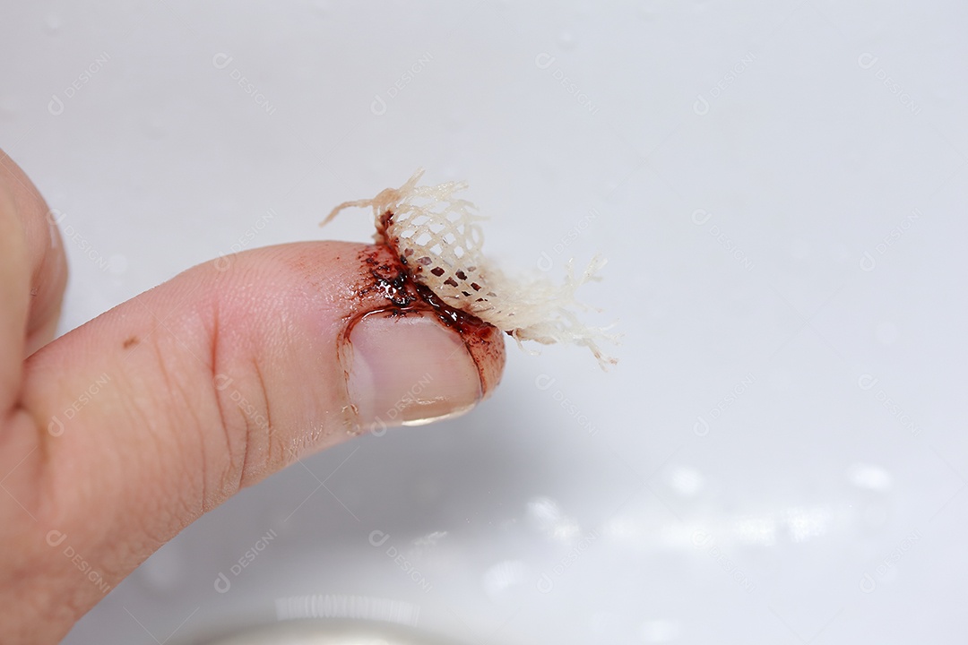 Close-up vista do dedo na mão humana do polegar esquerdo é cortado ferido.