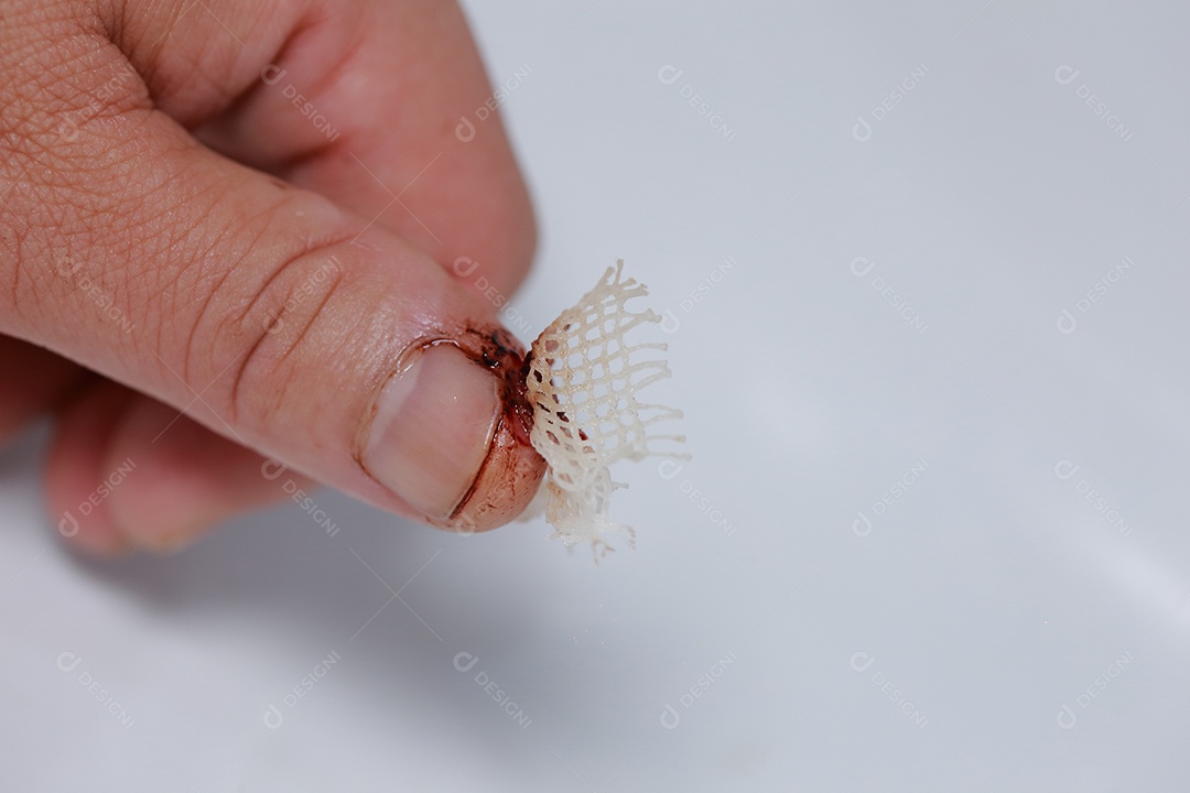 Close-up vista do dedo na mão humana do polegar esquerdo é cortado ferido.