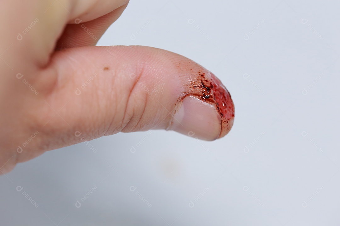 Close-up vista do dedo na mão humana do polegar esquerdo é cortado ferido.
