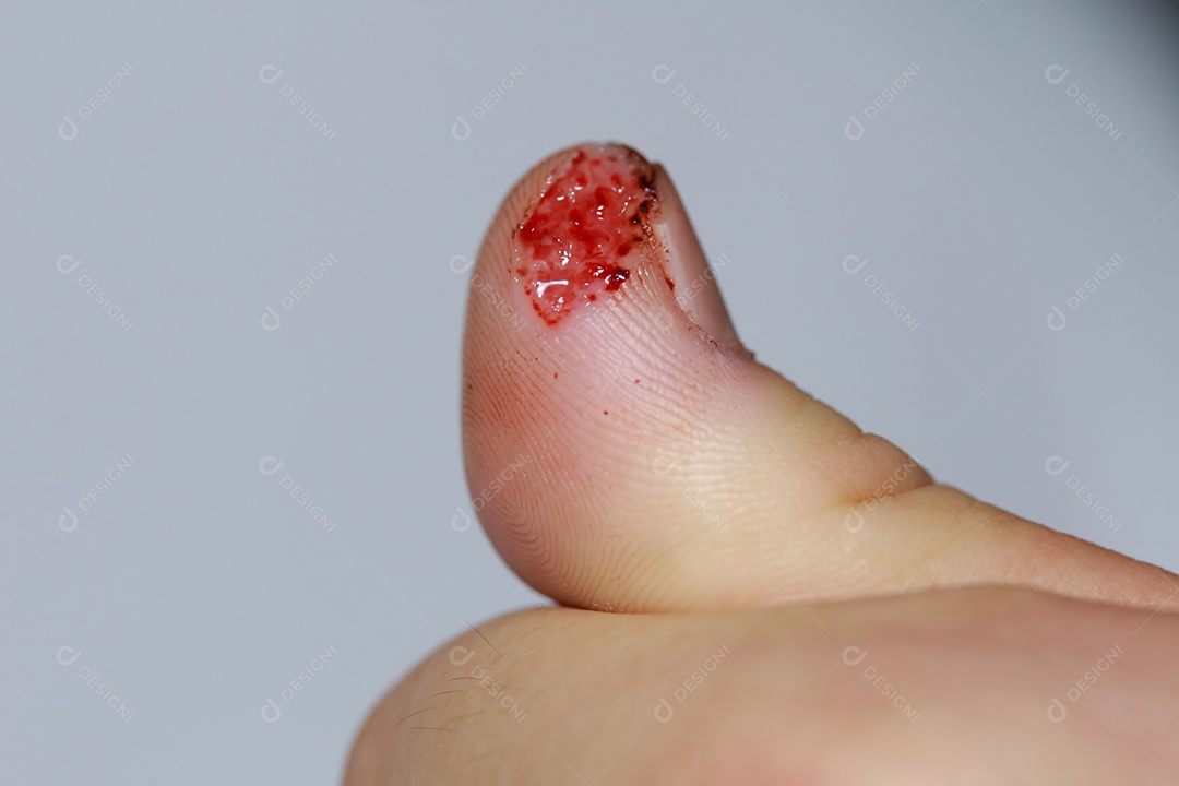 Close-up vista do dedo na mão humana do polegar esquerdo é cortado ferido.
