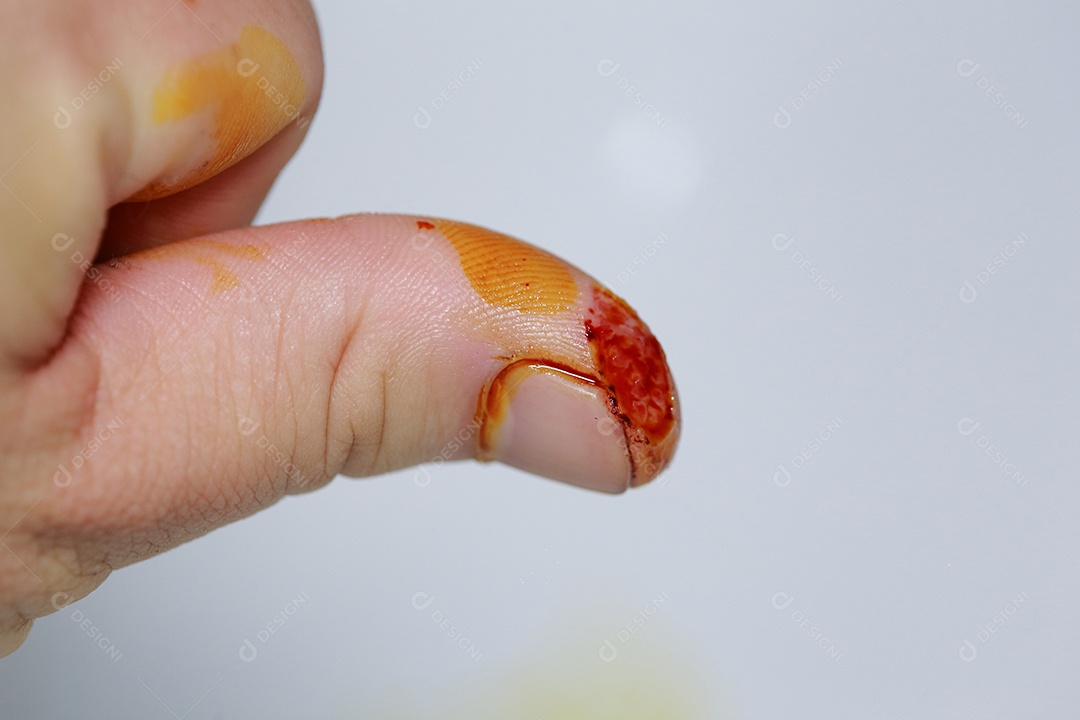 Close-up vista do dedo na mão humana do polegar esquerdo é cortado ferido.