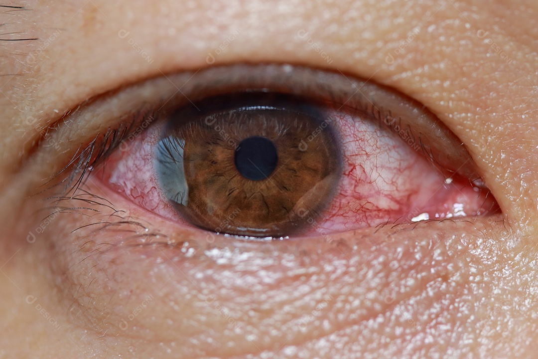 close-up de capilares no olho marca conjuntivite viral injetada durante o exame oftalmológico, olho ou após o choro.