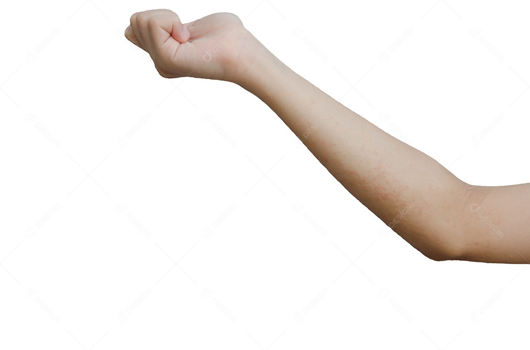 Erupção cutânea e pele nos braços, isolados no fundo branco. com caminho de recorte.