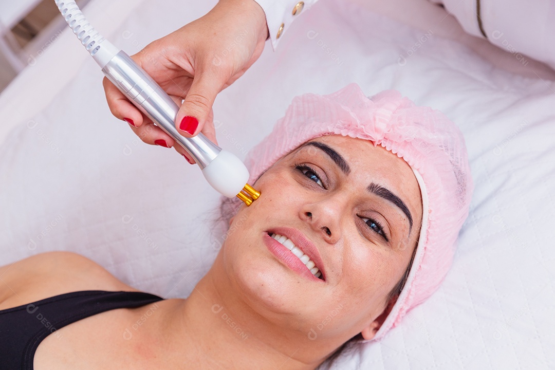 Facial radiofrequency application for melasma treatment