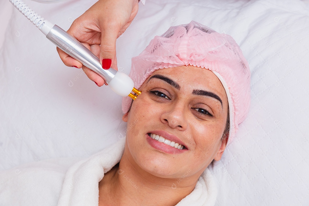 Aplicação de radiofrequência facial para tratamento de melasma