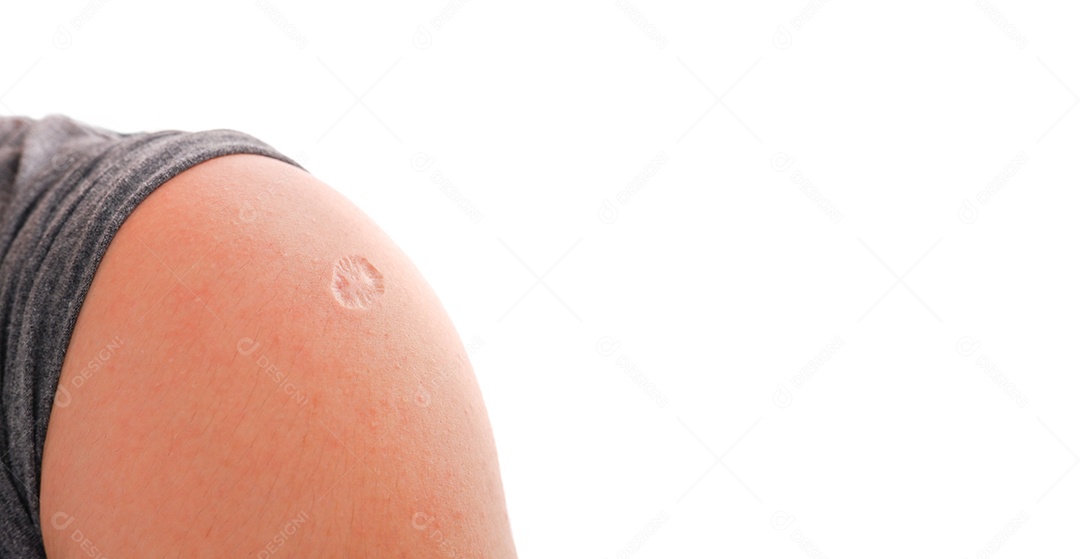 Cicatriz de vacina de varíola e varíola no ombro humano