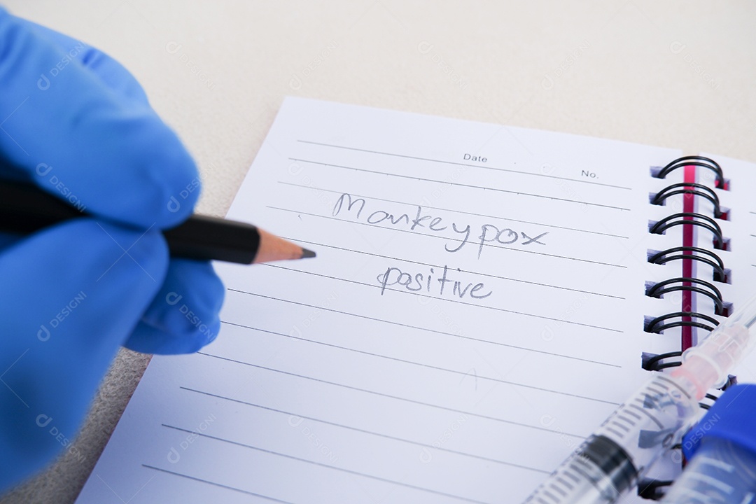 A mão do doutor escreve o resultado positivo do vírus da varíola dos macacos
