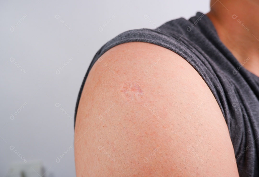 Cicatriz de vacina de varíola e varíola no ombro humano do pai