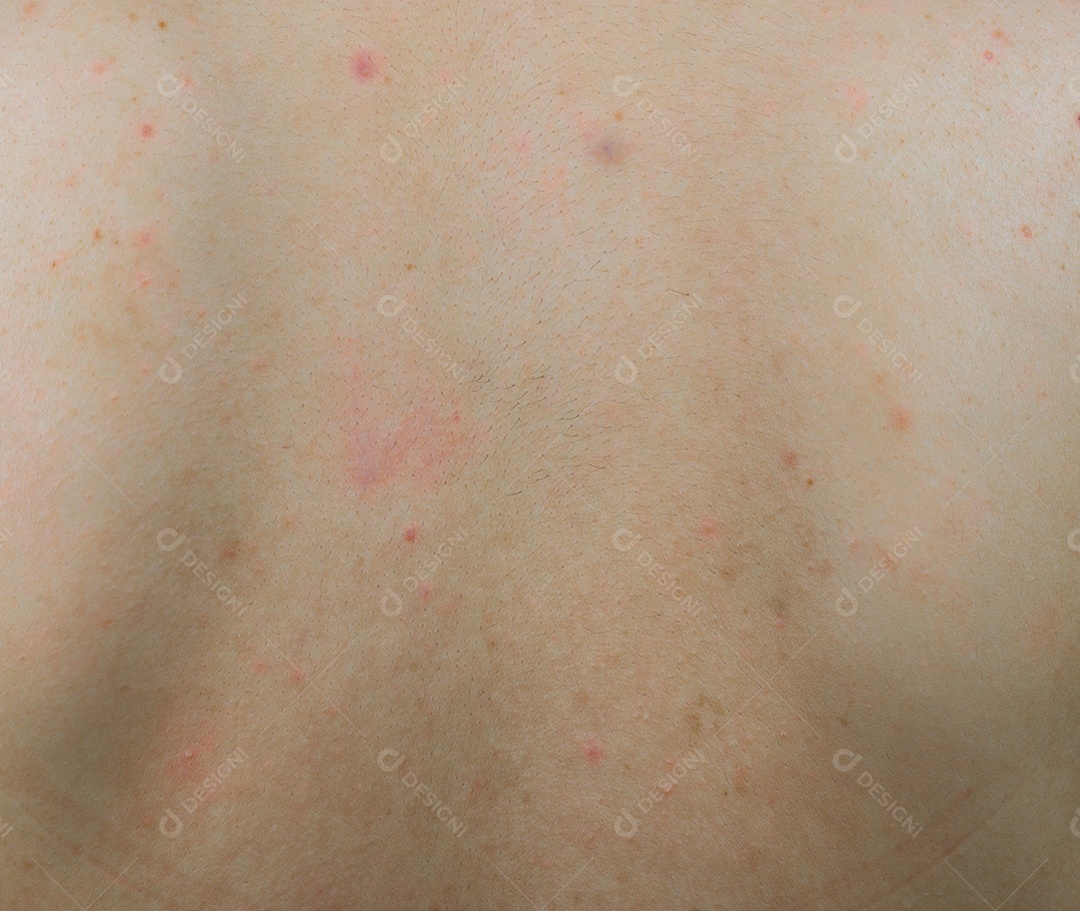 Detalhe de acne nas costas com mancha vermelha e mancha marrom escura na mulher