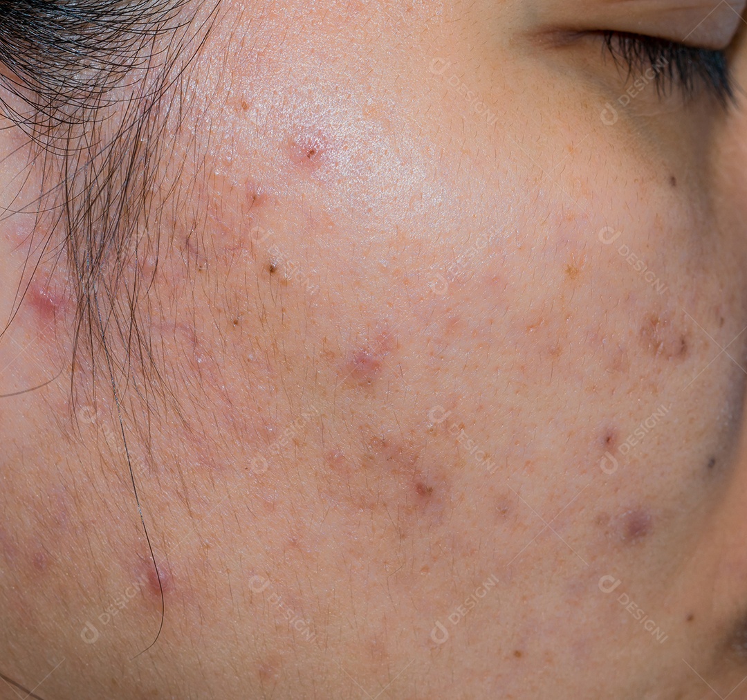 Acne e mancha de acne na pele oleosa do rosto da mulher asiática.