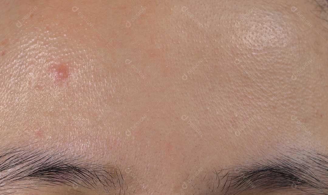 Acne na testa da mulher asiática da pele oleosa.