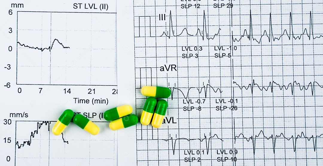 EKG ou ECG (Eletrocardiograma) papel de relatório gráfico.