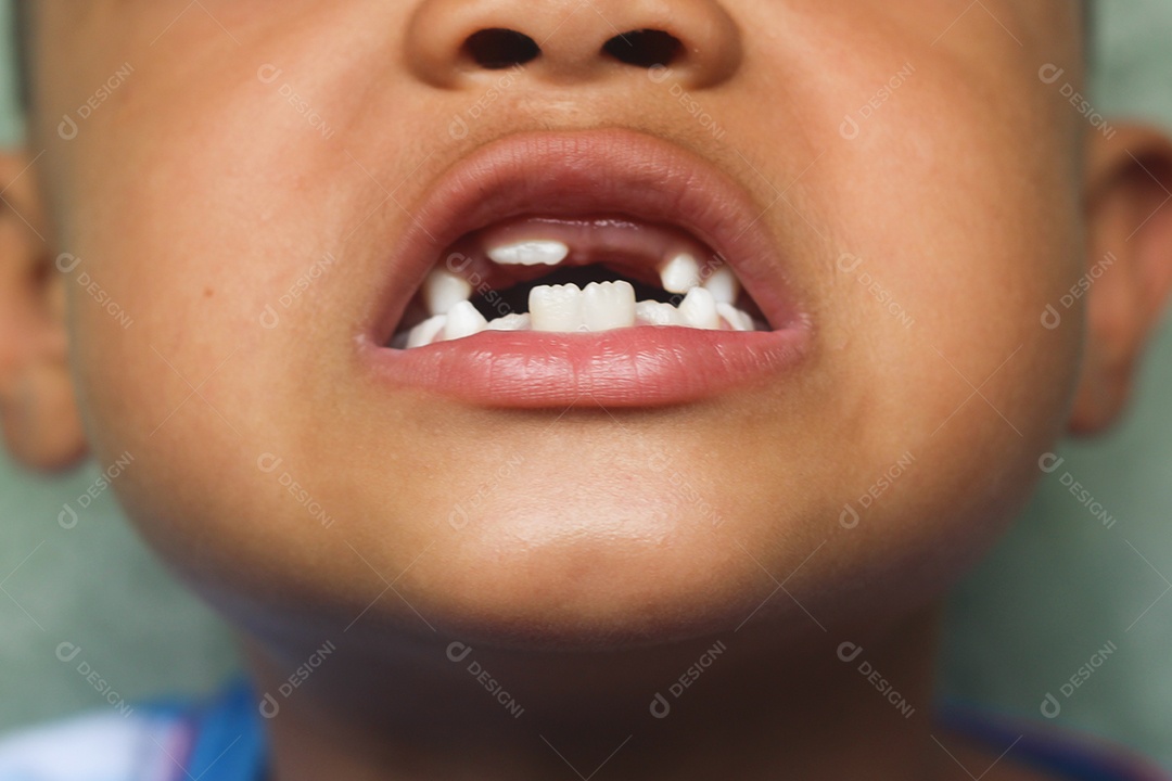 Menino mostrando seu dente perdido. A criança tem um dente de leite e um novo dente adulto cresce.