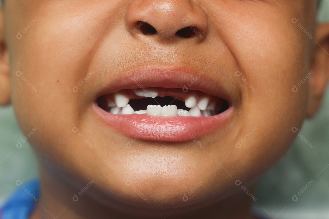 Menino mostrando seu dente perdido. A criança tem um dente de leite e um novo dente adulto cresce.