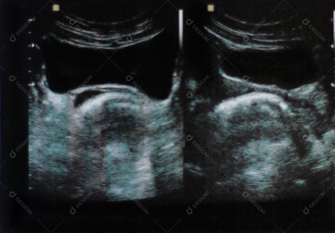 Ultrassom da bexiga - Imagens médicas de varredura do abdômen mostraram bexiga.