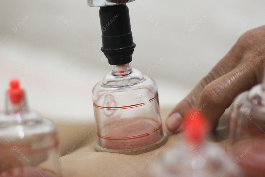 Procedimentos estéticos sendo praticando com pessoa