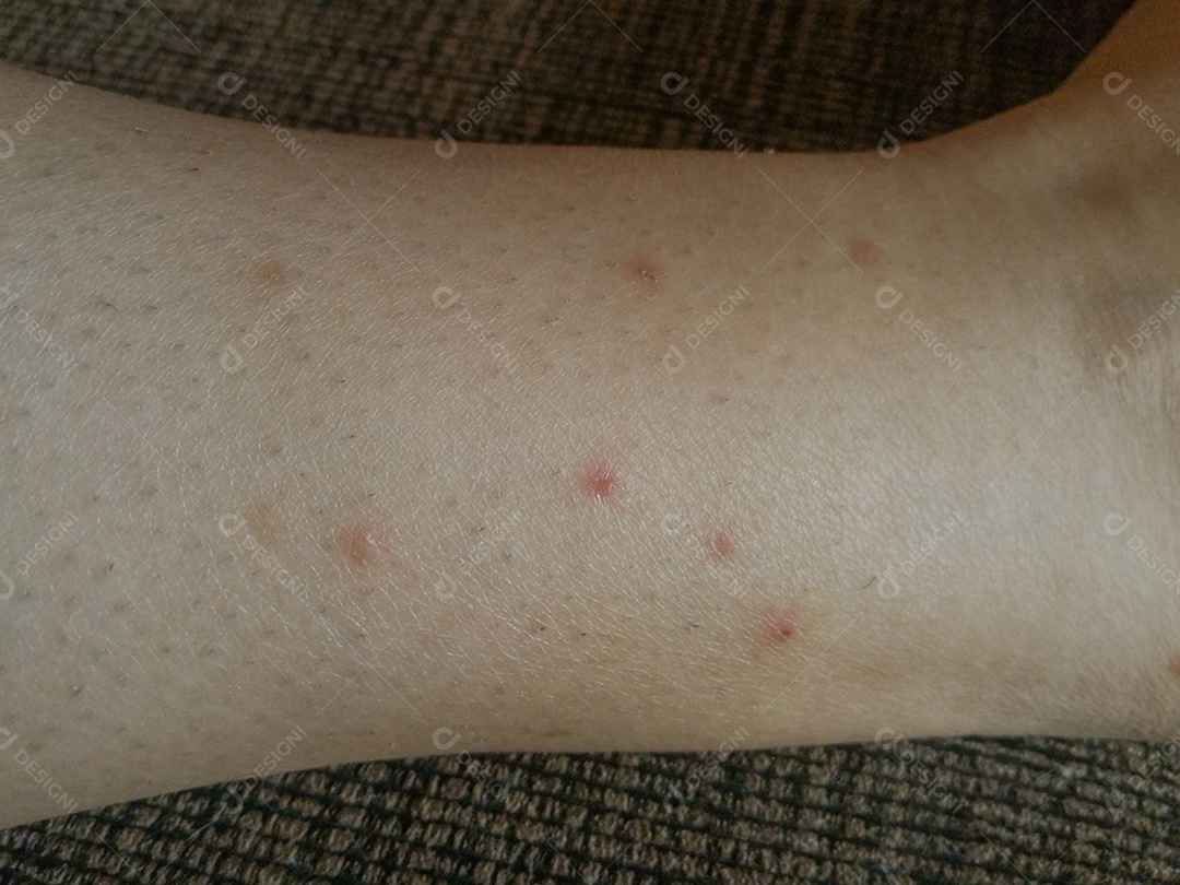 Pessoa mostrando picadas de mosquito alergia