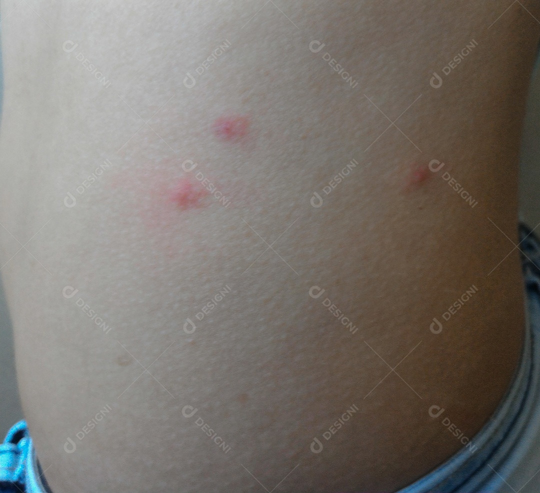 Pessoa mostrando picadas de mosquito alergia