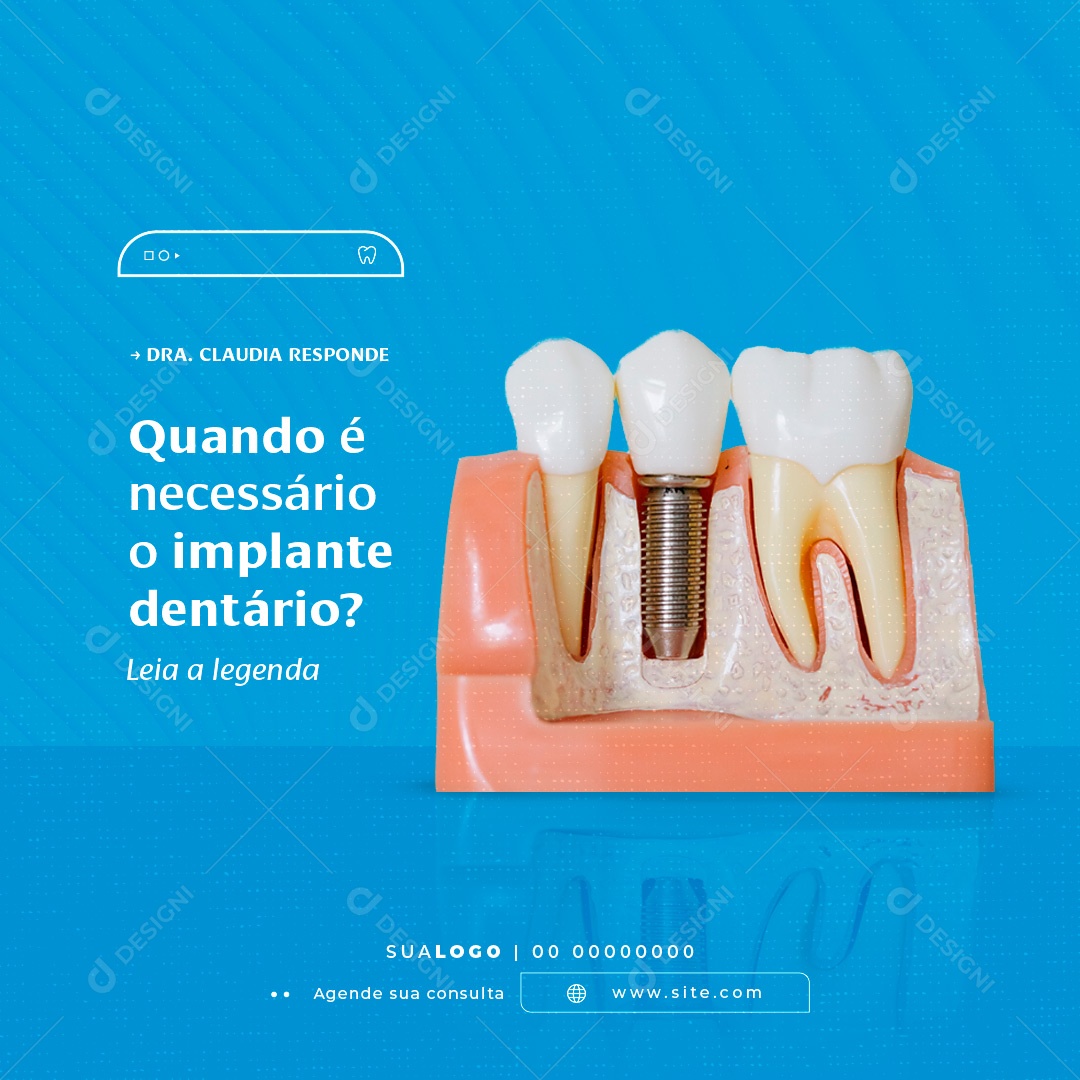 Social Media Dentista Implante Dentário PSD Editável