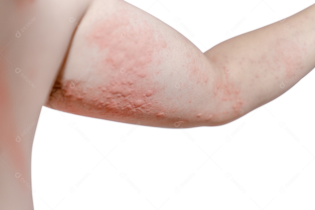 A dermatite atópica (eczema) ocorre ao redor do braço e deixa a pele vermelha com coceira.