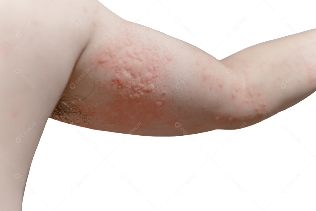 A dermatite atópica (eczema) ocorre ao redor do braço e deixa a pele vermelha com coceira.