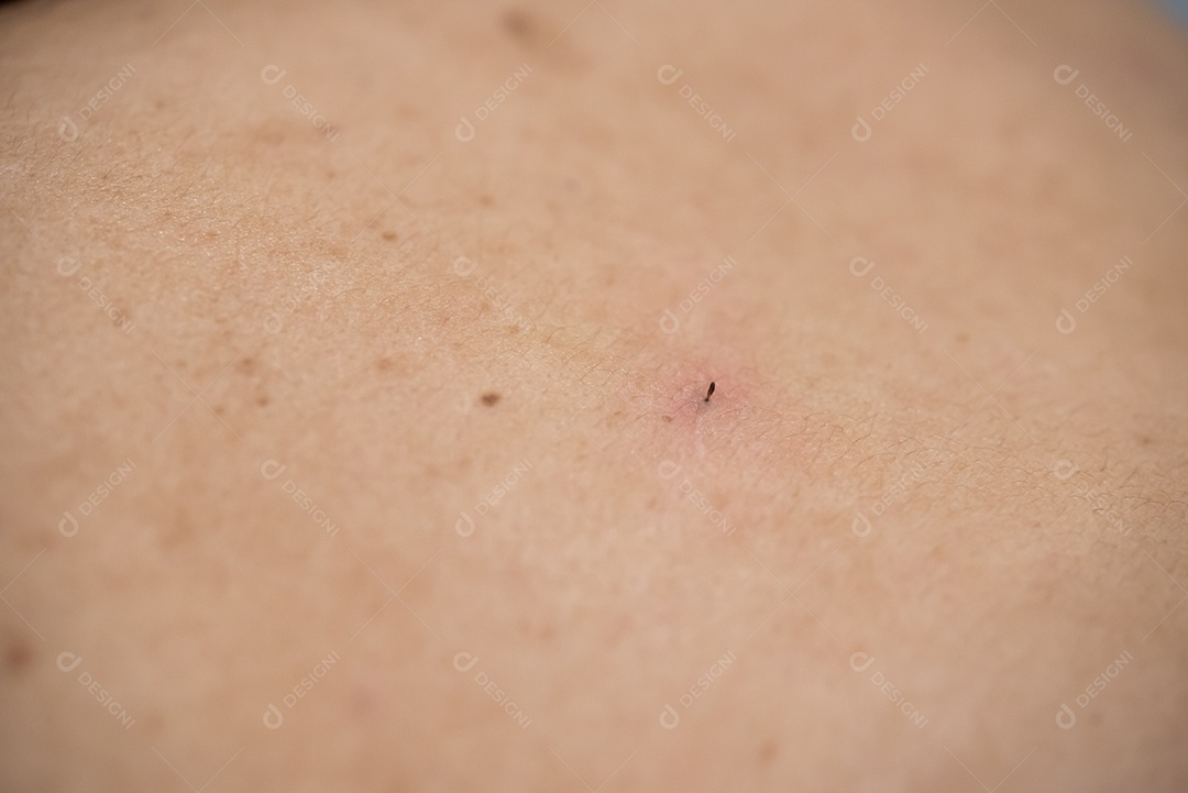 Acne nas costas da mulher de cuidados com a pele é causada por bactérias.