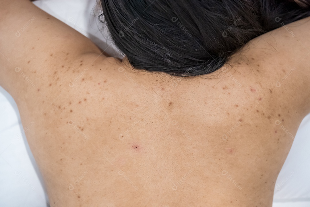 Acne nas costas da mulher de cuidados com a pele é causada por bactérias.