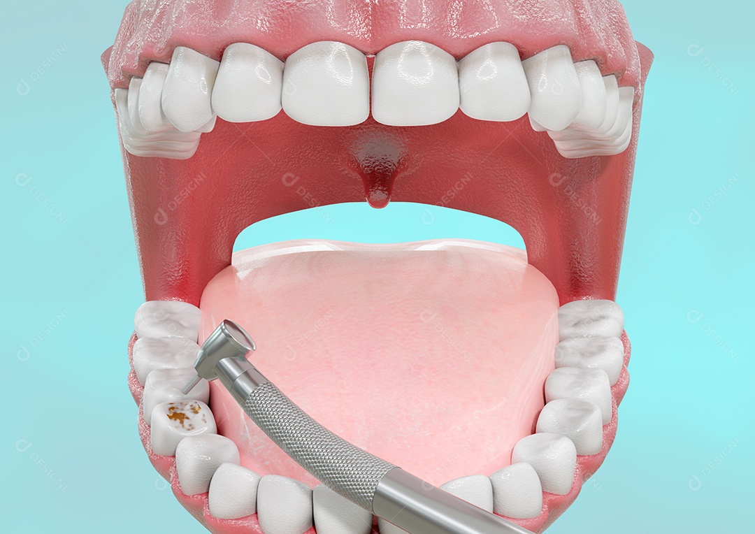 Processo de remoção de cárie de dente humano com máquina de perfuração. ilustração 3D