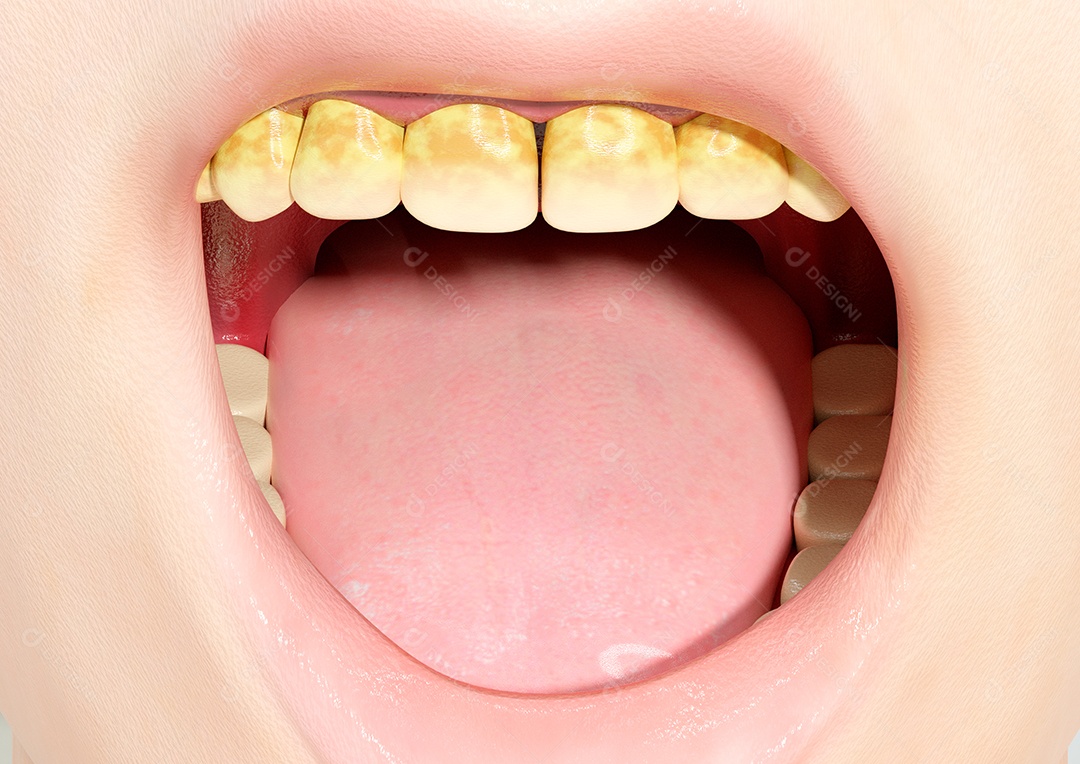 Tártaro em dentes humanos causa calcificação da placa bacteriana