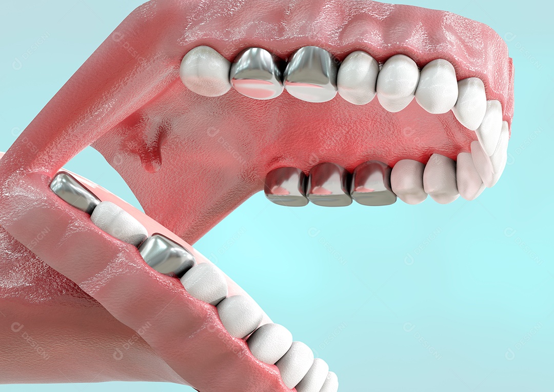 Prótese de coroa metálica substituindo o dente humano natural. ilustração 3D