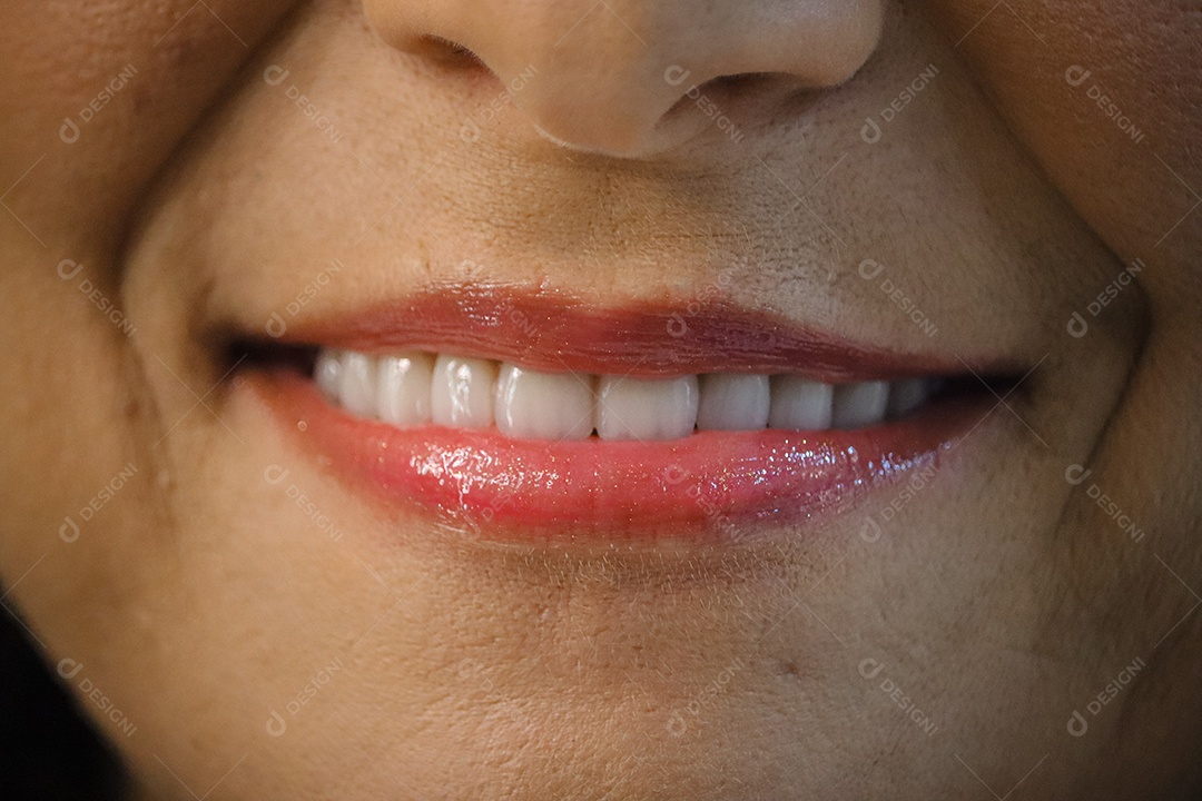 Mulher madura sorrindo com lentes de clareamento dental