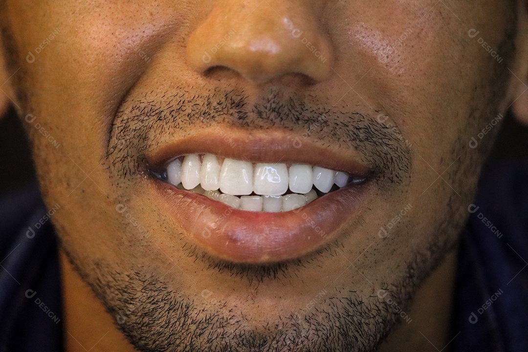 Homem moreno sorrindo com lentes de clareamento dental