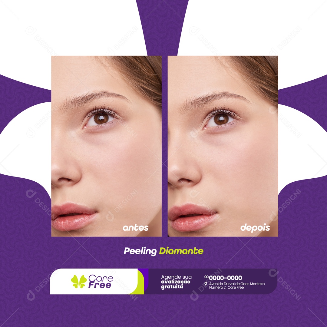 Antes e Depois Peeling Diamante SPA Social Media PSD Editável