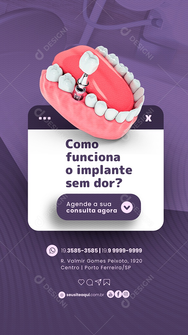 Story Como Funciona o Implante sem Dor Dentista Social Media PSD Editável