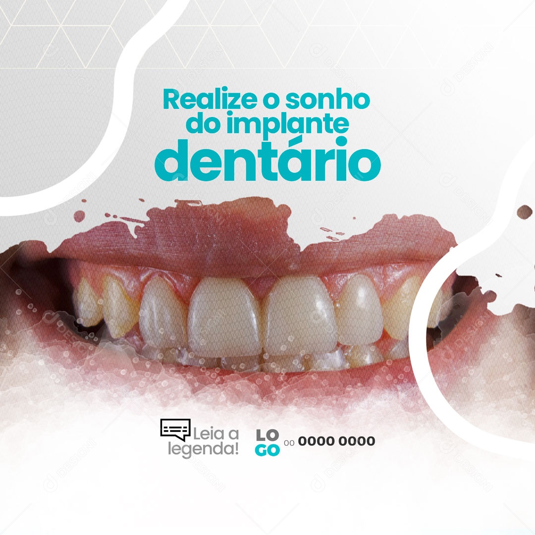 Realise o Sonho do Implante Dentário Consultório Odontológicos Dentista Social Media PSD Editável