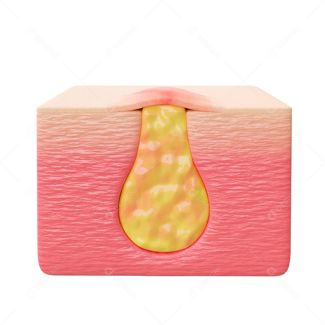 Acne é o processo inflamatório das glândulas sebáceas