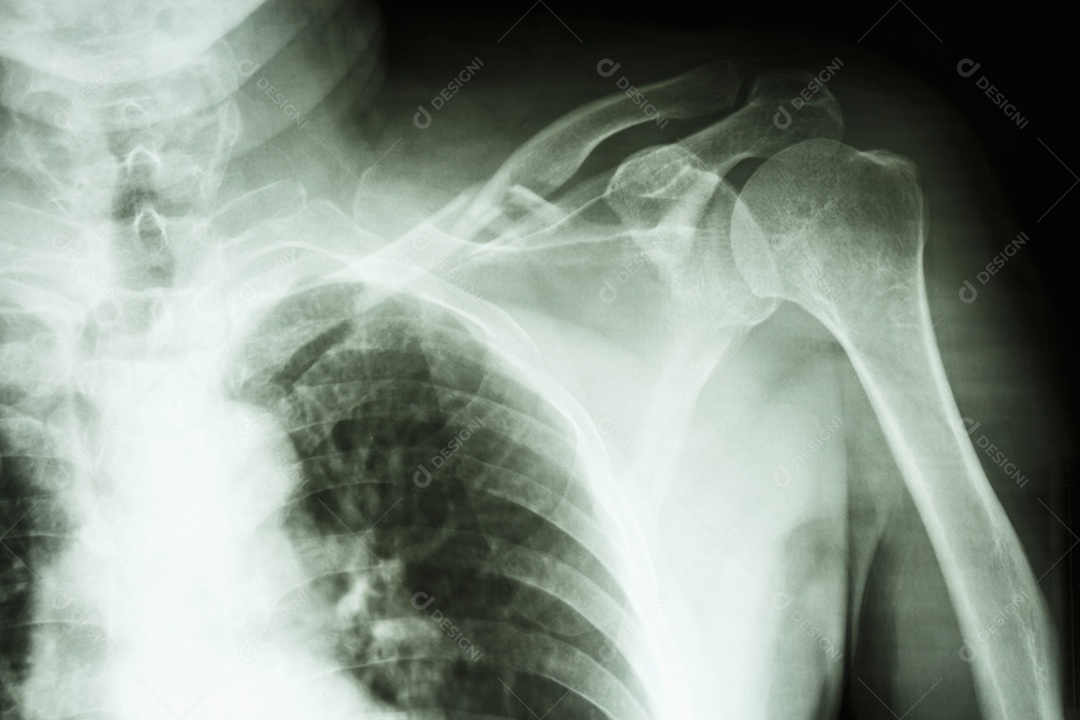 Fratura cominutiva do terço médio da clavícula esquerda