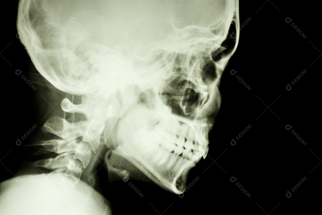 Radiografia de filme mostrando crânio e coluna cervical normais na face lateral