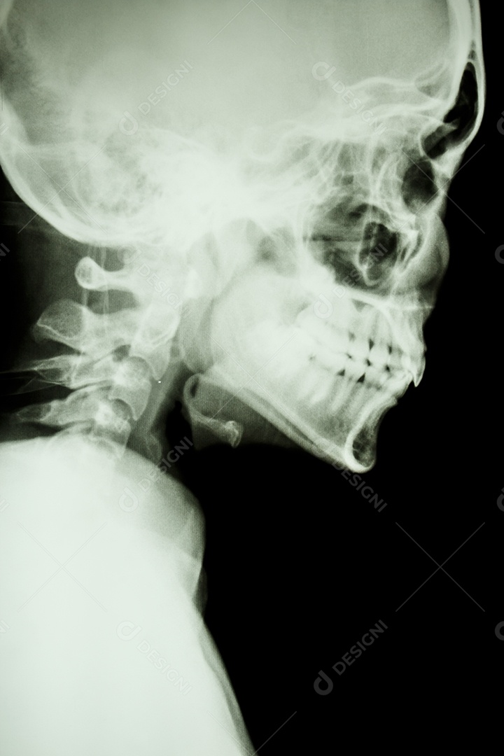 Radiografia de filme mostrando crânio e coluna cervical normais na face lateral