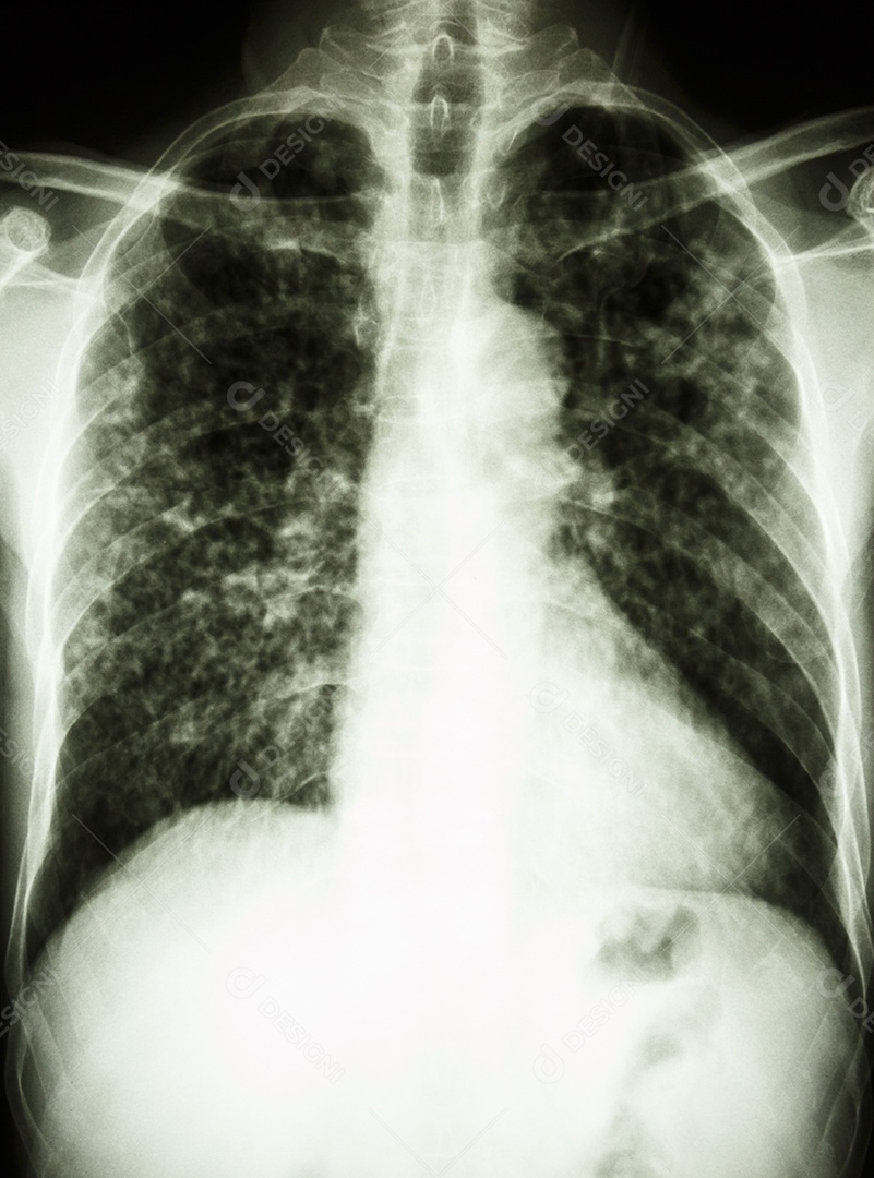 Tuberculose pulmonar raio x completo