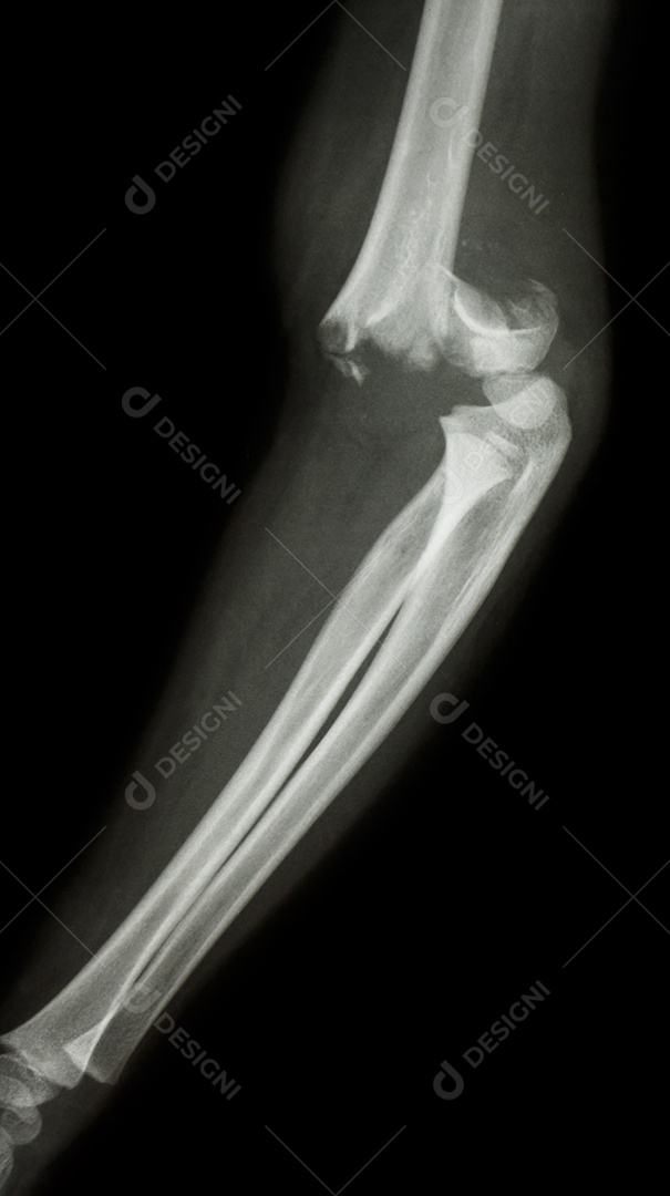 Filme de raio X do cotovelo mostra fratura supracondilar do úmero
