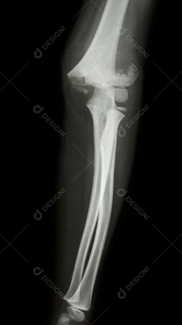 Filme de raio X do cotovelo mostra fratura supracondilar do úmero