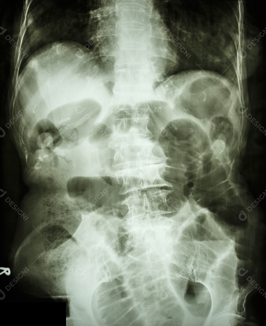 Radiografia de abdome em decúbito dorsal mostrando intestino delgado dilatado