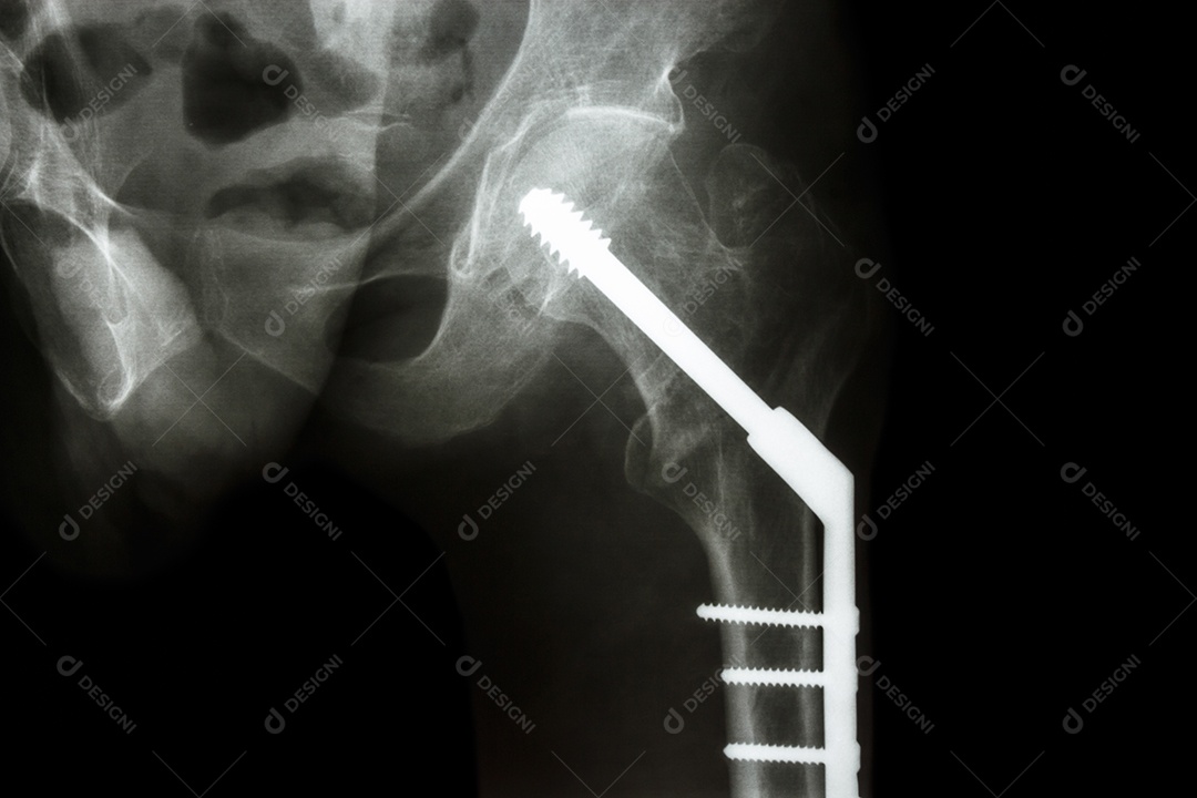 Raio x do quadril esquerdo mostra fratura do colo do fêmur