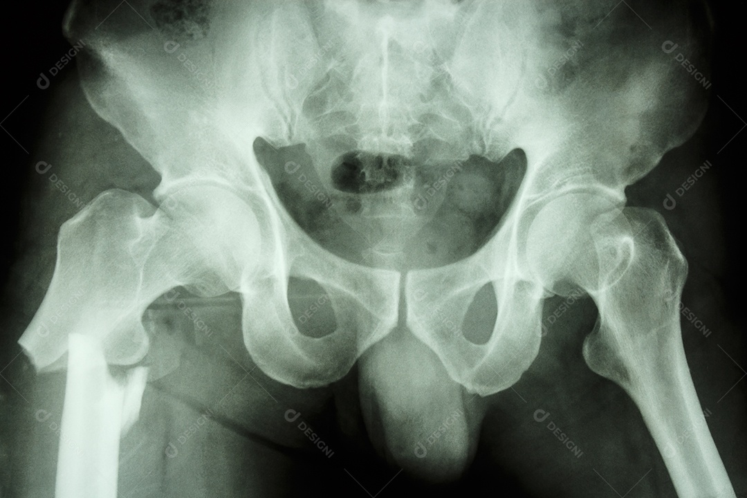 Filme raio x pélvico AP mostra fratura do fêmur direito