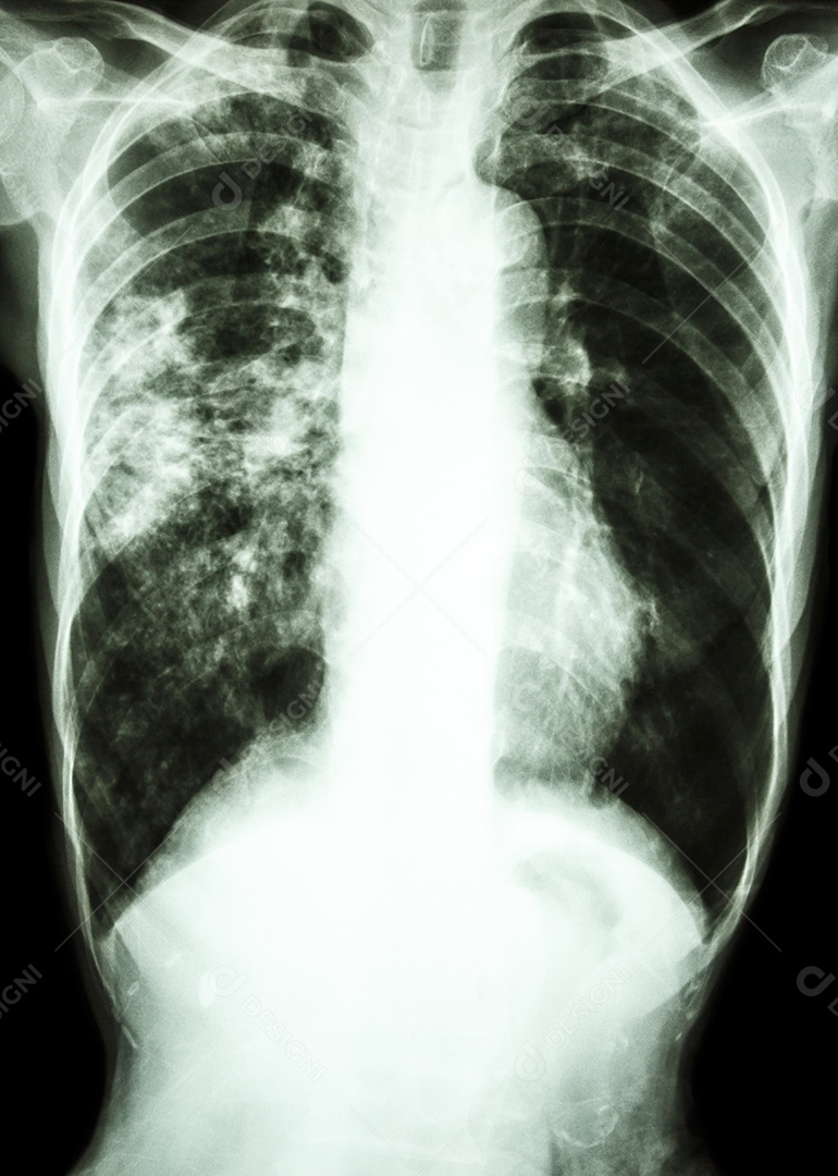 Infecção por Mycobacterium tuberculosis tuberculose pulmonar