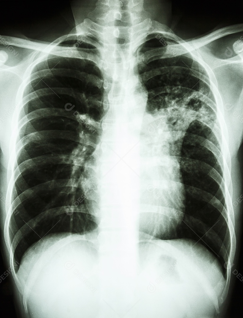 Tuberculose pulmonar raio x completo