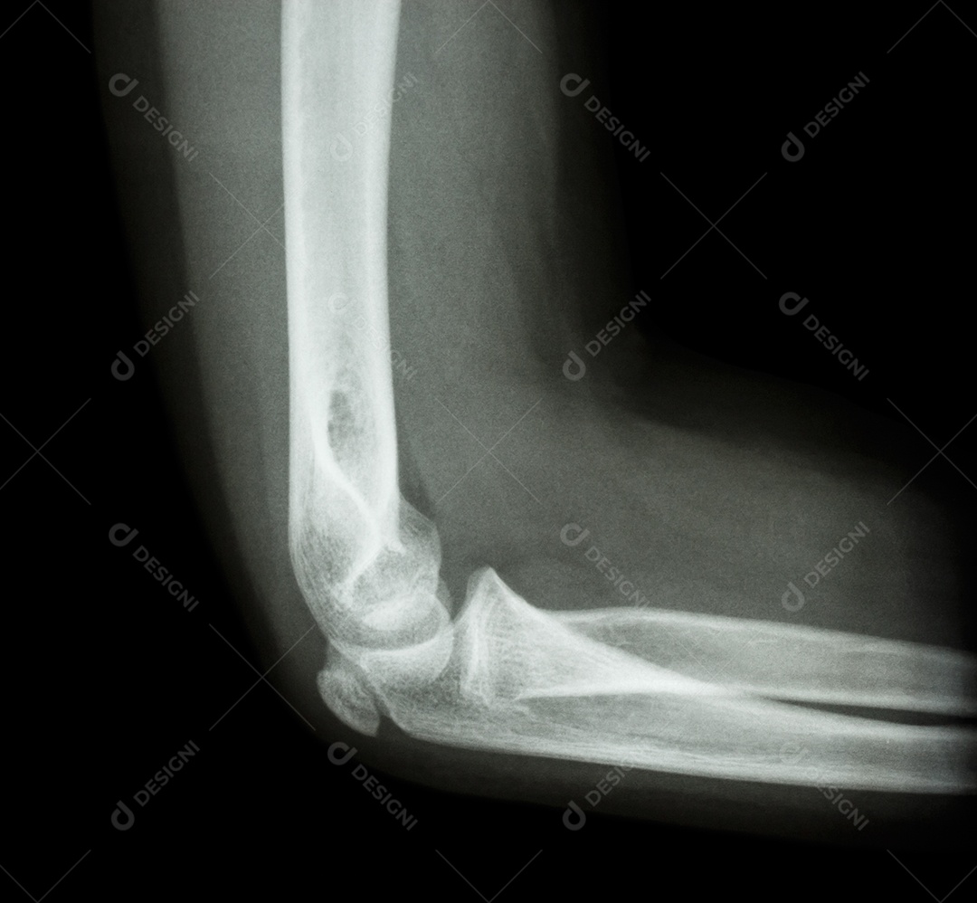 Raio x lateral do cotovelo mostra o cotovelo humano normal