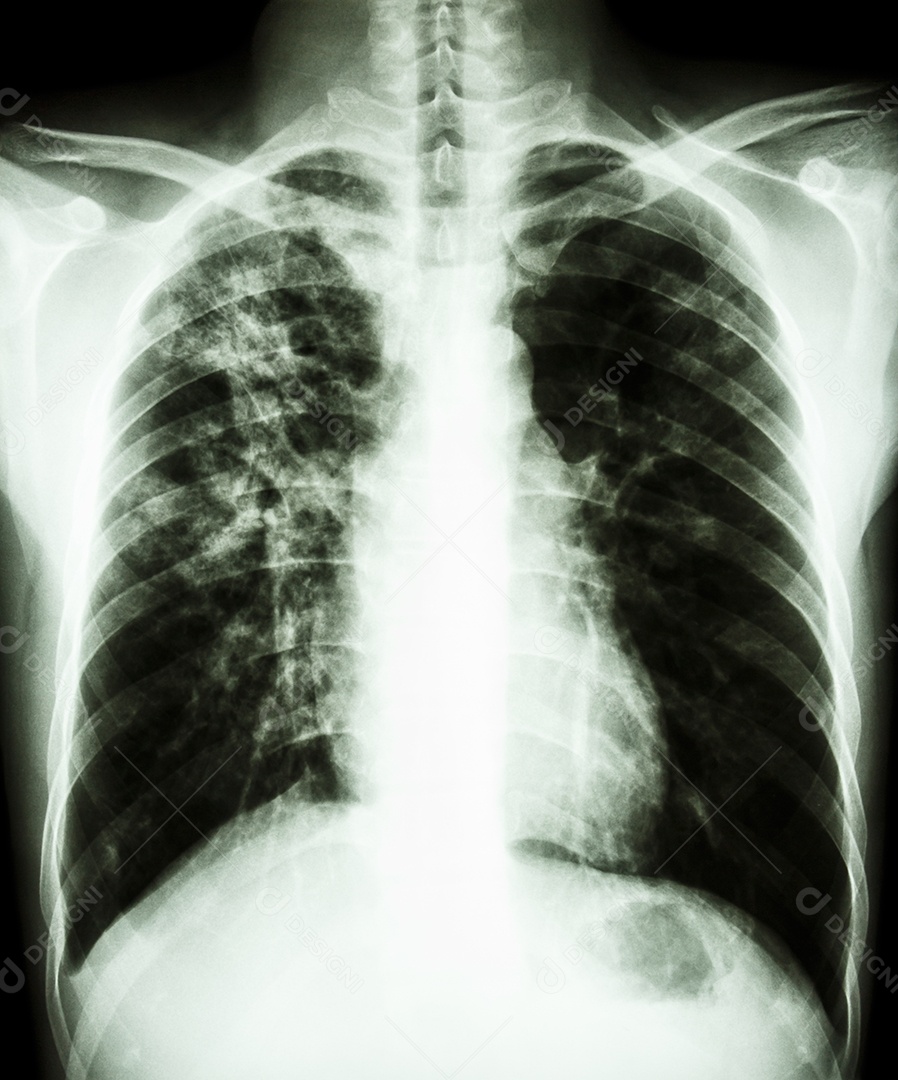Tuberculose pulmonar raio x completo